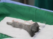 Image: Cho Ray Hospital successfully applies new technique in bone surgery