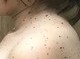 Image: First case of Noonan syndrome discovered in Vietnam