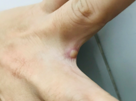 Image: Vietnam detects second case of monkeypox in HCMC