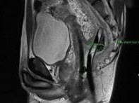 Image: Rare Medical Case: Patient Treated for Unprecedented Injury