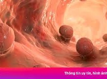 Image: Colorectal Cancer Rates Surge in Ho Chi Minh City