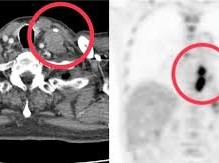 Image: Man Diagnosed with Two Types of Cancer Due to Long-Term Habits
