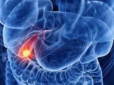 Image: Unexpected Late-Stage Cancer Diagnosis Despite Good Health