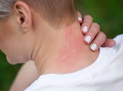 Image: Rising Allergy Cases: Doctors Explain the Causes