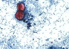 Image: Diarrhea Outbreak in Michigan Linked to Lettuce and Salad Greens