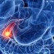 Image: Unexpected Late-Stage Cancer Diagnosis Despite Good Health
