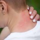 Image: Rising Allergy Cases: Doctors Explain the Causes