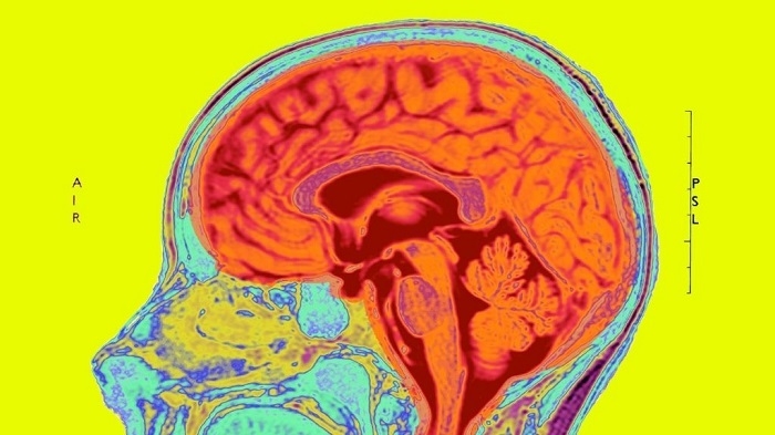 COVID-19 can cause brain shrinkage, memory loss - study