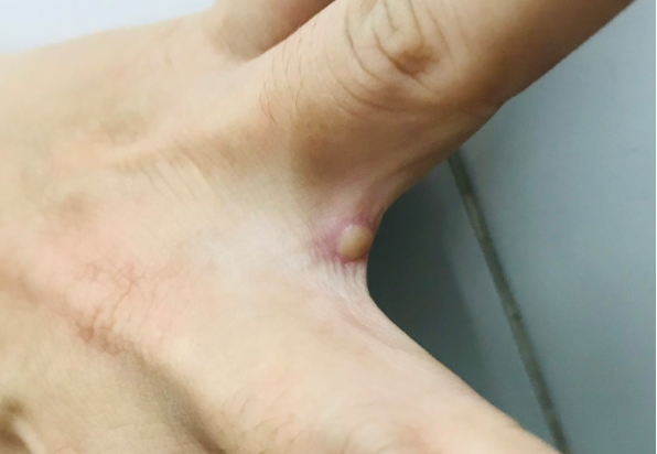 Vietnam detects second case of monkeypox in HCMC
