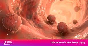 Colorectal Cancer Rates Surge in Ho Chi Minh City