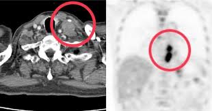 Man Diagnosed with Two Types of Cancer Due to Long-Term Habits