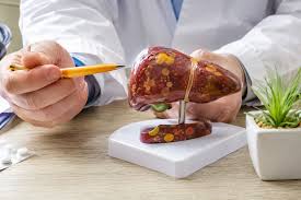 Rising Fatty Liver Disease Among Non-Drinkers: Causes and Solutions