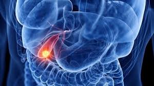 Unexpected Late-Stage Cancer Diagnosis Despite Good Health
