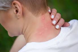 Rising Allergy Cases: Doctors Explain the Causes
